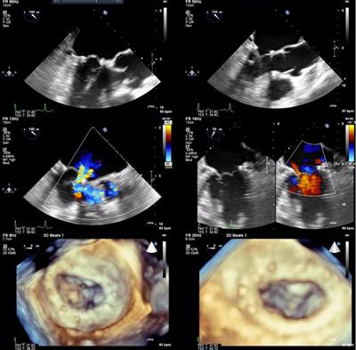 Echocardiographic and clinical outcomes following beating heart NeoChord DS1000 mitral valve repair: a single centre case series